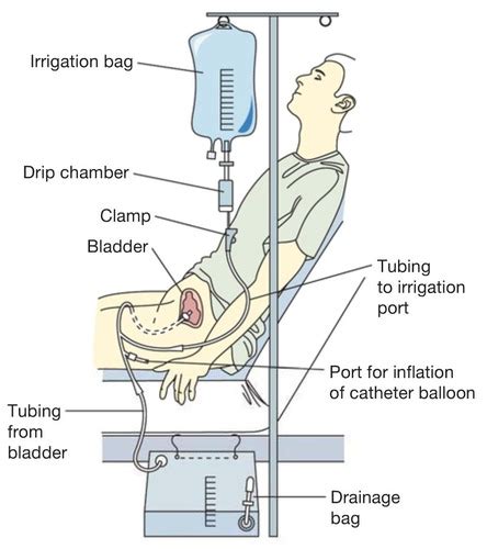 Cbi Continuous Bladder Irrigation In Medical By Acronymsandslang Com