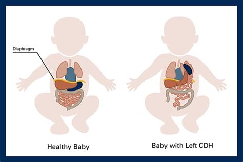 Cdh Medical Abbreviation