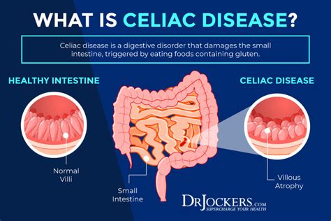Celiac Disease Symptoms Diagnosis Treatment