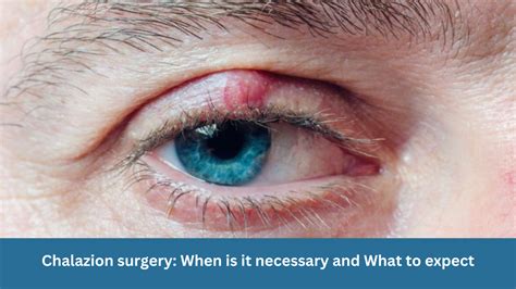 Chalazion Causes Treatment And Surgery Youtube Chalazion Causes Treatment And Surgery Youtube