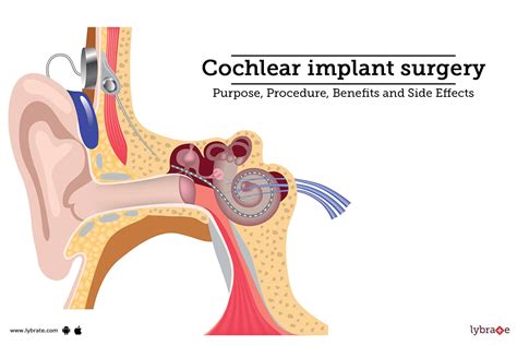 5 Cochlear Surgery Costs