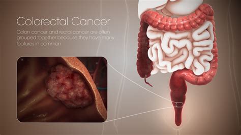 Colorectal Cancer Pictures