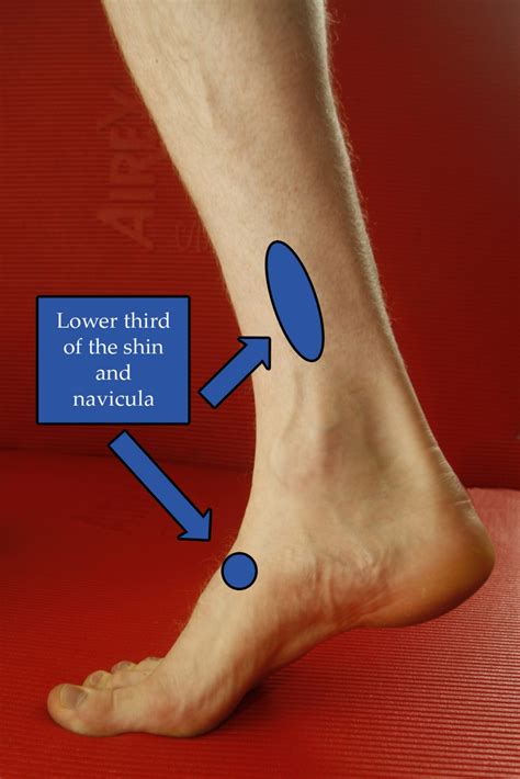 Common Stress Fracture Sites In The Shin Witty Pask Buckingham