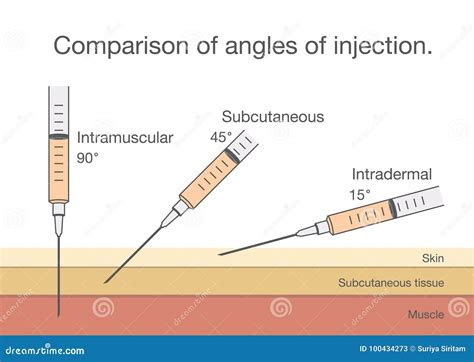 Comparison Of The Angles Of Insertion For Intramuscular Im