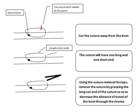 Corneal Suture Removal Eyedocs