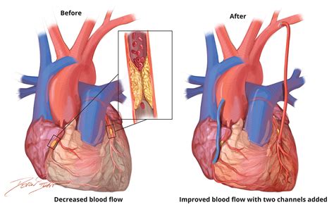 Coronary Artery Bypass Graft Surgery Johns Hopkins Medicine