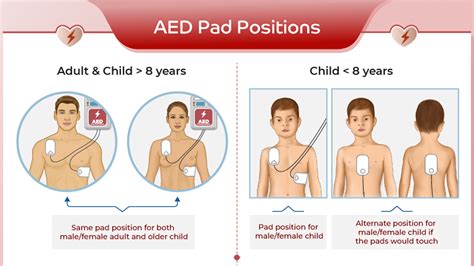 Correct Approach For Aed Pad Placement For Infants And Children