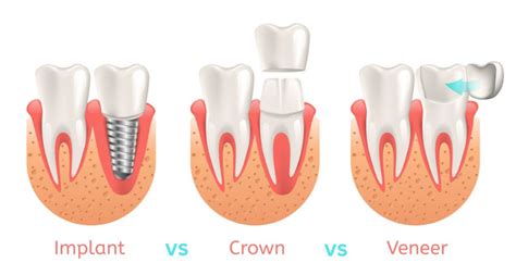 Crowns Vs Porcelain Veneers Vs Dental Implants And When To Use Which