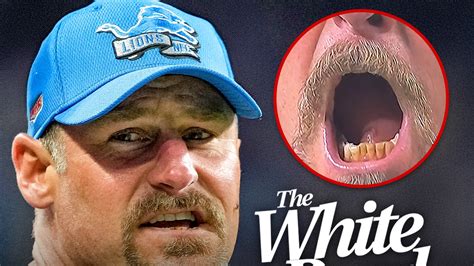 Dan Campbell Offered Lifetime Supply Of Teeth Whitening Product