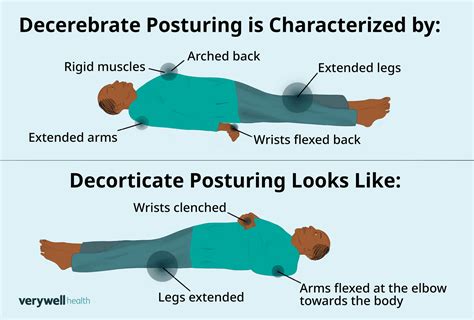 Decorticate And Decerebrate Posturing