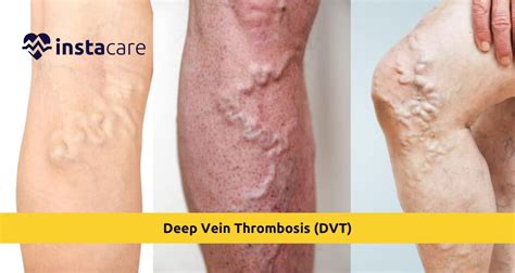 Deep Vein Thrombosis Dvt Warnings Signs Treatment