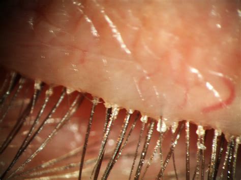 Demodex Eyelash Mites Demodex Eyelash Mites