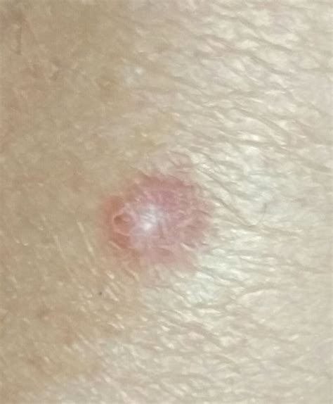 Dermatofibroma Icd 10 D23 Online Consultation Ai Dermatologist