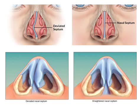 Deviated Nasal Septum Medical Devices