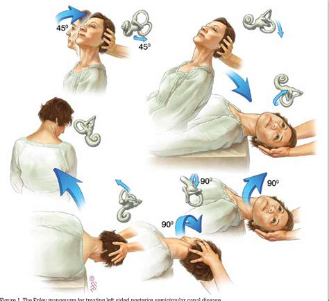 Diagram Of Epley Maneuver