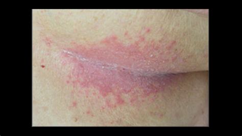 Diaper Rash And Perianal Dermatitis Basicmedical Key Vrogue Co