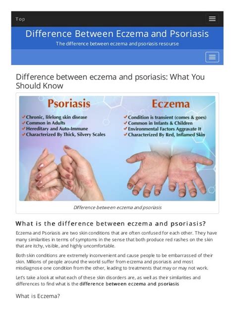 Difference Between Eczema And Psoriasis Nhs At Catherine Dorsey Blog