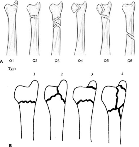Distal Radius And Ulnar Fractures Musculoskeletal Key Vrogue Co