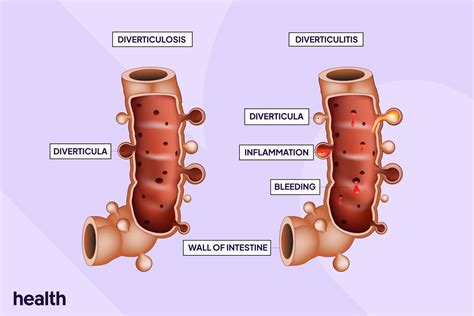 Diverticulitis Life Expectancy