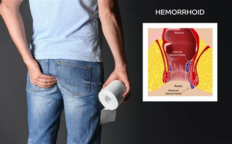 Do Hemorrhoids Flare Up With Stress Hemorrhoids Hemorrhoids
