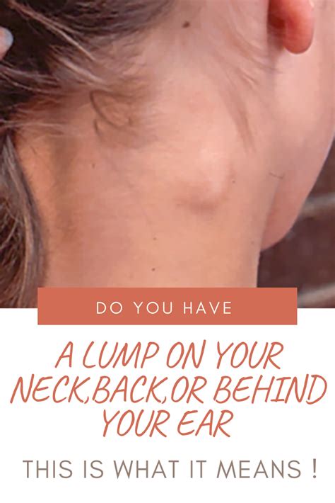 Do You Have Got A Lump On Your Neck Back Or Behind Your Ear This