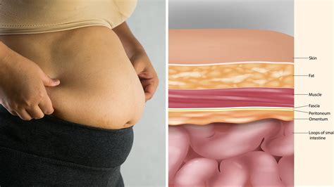 Doctors Explain How To Lose Belly Fat Without Exercise Power Of