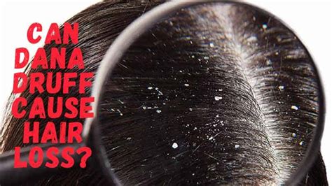 Does Dandruff Cause Hair Loss