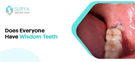 5 Wisdom Teeth Facts