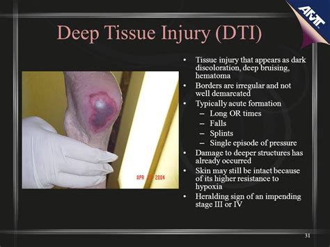Dti Wound Suspected Deep Tissue Injury 2023