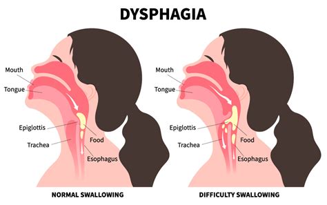 Dysphagia Swallowing Difficulty Nutrimedical