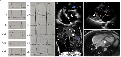 Ecg Tte And Cmr Of Case 1 A Ecg Of Case 1 Sinus Rhythm