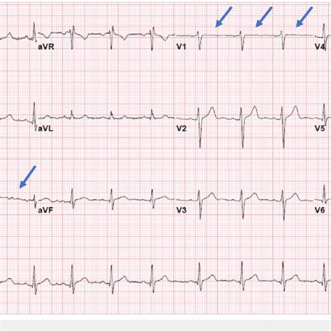 Ecg Upon Admission Admission Ecg Showing Non Specific St Segment