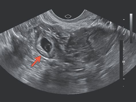 Ectopic Pregnancy Nejm
