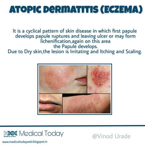Eczema And Atopic Dermatitis Rashes Causes Symptoms