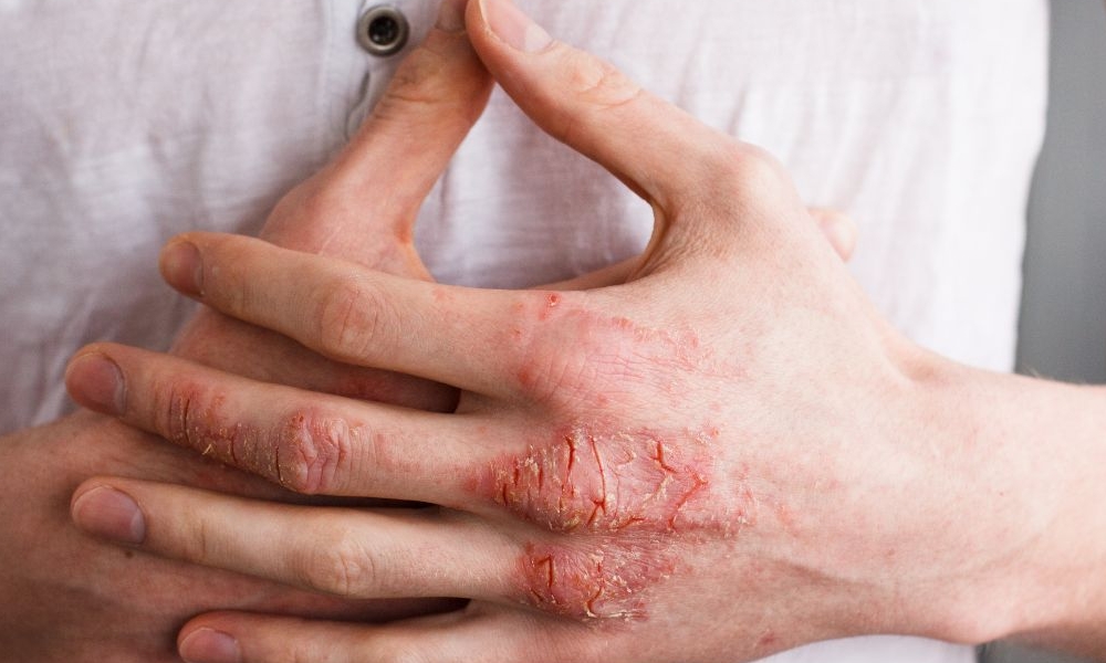 Eczema Hand Face Baby Causes Symptoms Treatment