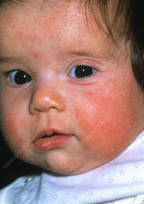 Eczema On Baby S Face Stock Image M150 0191 Science Photo Library