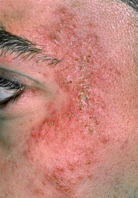 Eczema On The Side Of A Man S Face Stock Image M150 0121 Science