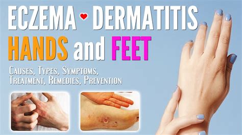 Eczema Rash On Hands And Feet At Mark Cox Blog