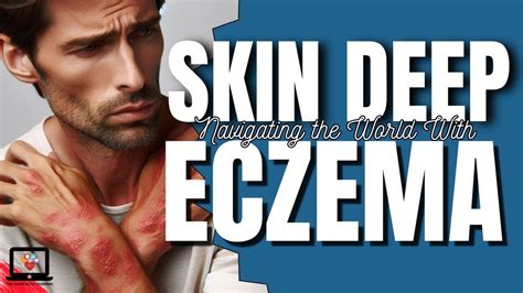 Eczema Skin Deep