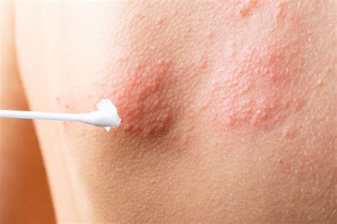 Eczema Vs Shingles Symptoms Causes And Treatment