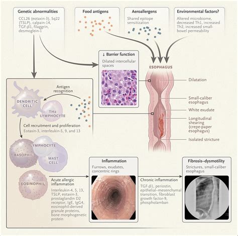Eosinophilic Esophagitis Nejm Eosinophilic Esophagitis Nejm
