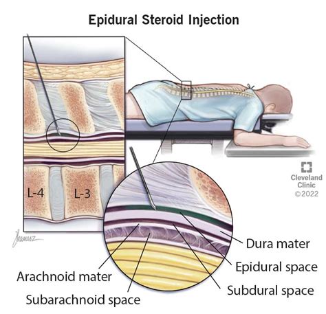 Epidural Steroid Injection Esi What It Is Benefits Risks Results