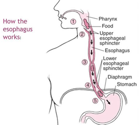 Esophageal Motility Disorder