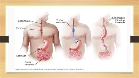 Esophageal Surgery Dysphagia Vs Odynophagia Oropharyngeal Dysphagia Loss