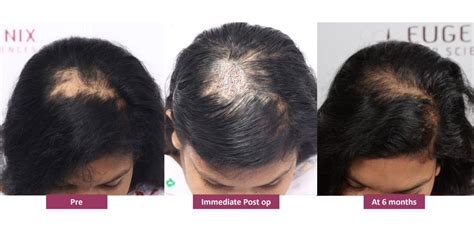 Everything You Need To Know About Hair Restoration For Women Eugenix Hair Sciences Pvt Ltd