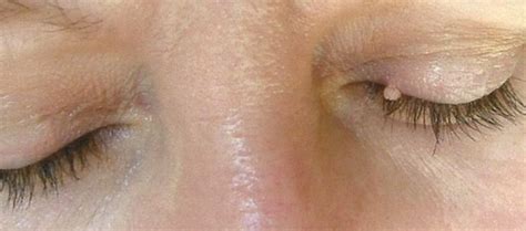 Everything You Need To Know About Skin Tag On Eyelid Dr Bratt Everything You Need To Know About Skin Tag On Eyelid Dr Bratt