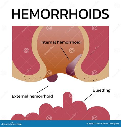 External Hemorrhoids Photos