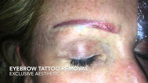 Eyebrow Tattoo Removal By Exclusive Aesthetic Youtube