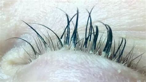 Eyelash Mites Pictures