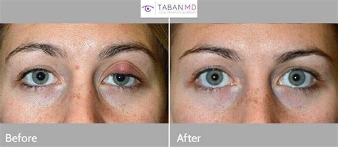 Eyelid Chalazion Surgery Before And After Gallery Taban Md Eyelid Chalazion Surgery Before And After Gallery Taban Md